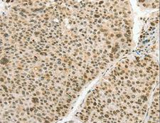 ANGPT4 / Angiopoietin-4 Antibody - Immunohistochemistry of paraffin-embedded Human liver cancer using ANGPT4 Polyclonal Antibody at dilution of 1:70.