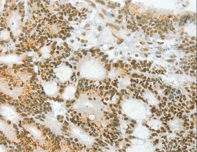 ANGPT4 / Angiopoietin-4 Antibody - Immunohistochemistry of paraffin-embedded Human colon cancer using ANGPT4 Polyclonal Antibody at dilution of 1:70.