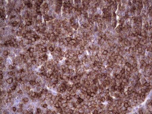 ANGPTL1 Antibody - Immunohistochemical staining of paraffin-embedded Human lymphoma tissue using anti-ANGPTL1 mouse monoclonal antibody. (Heat-induced epitope retrieval by 1 mM EDTA in 10mM Tris, pH8.5, 120C for 3min,