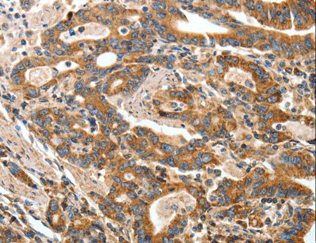 ANGPTL1 Antibody - Immunohistochemistry of paraffin-embedded Human liver cancer using ANGPTL1 Polyclonal Antibody at dilution of 1:40.