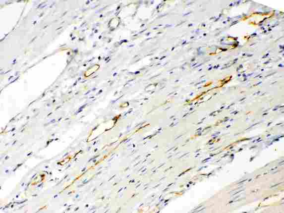 ANGPTL2 / ARP2 Antibody - ANGPTL2 was detected in paraffin-embedded sections of human intetsinal cancer tissues using rabbit anti- ANGPTL2 Antigen Affinity purified polyclonal antibody