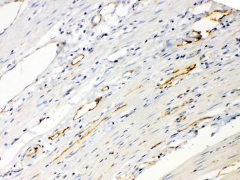 ANGPTL2 / ARP2 Antibody - IHC testing of FFPE human intestinal cancer tissue with ANGPTL2 antibody at 1ug/ml. Required HIER: steam section in pH6 citrate buffer for 20 min and allow to cool prior to testing.