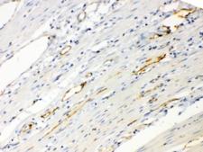 ANGPTL2 / ARP2 Antibody - IHC testing of FFPE human intestinal cancer tissue with ANGPTL2 antibody at 1ug/ml. Required HIER: steam section in pH6 citrate buffer for 20 min and allow to cool prior to testing.