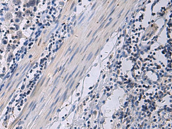 ANGPTL2 / ARP2 Antibody - Immunohistochemistry of paraffin-embedded Human esophagus cancer tissue  using ANGPTL2 Polyclonal Antibody at dilution of 1:55(×200)