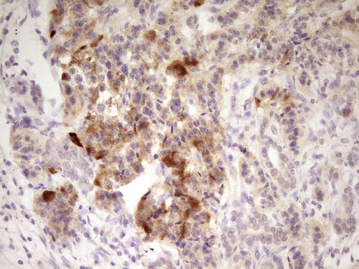 ANGPTL3 Antibody - Immunohistochemical staining of paraffin-embedded Carcinoma of Human pancreas tissue using anti-ANGPTL3 mouse monoclonal antibody. (Heat-induced epitope retrieval by 1 mM EDTA in 10mM Tris, pH8.5, 120C for 3min,