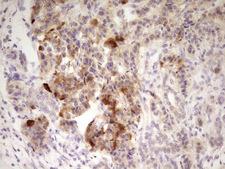 ANGPTL3 Antibody - Immunohistochemical staining of paraffin-embedded Carcinoma of Human pancreas tissue using anti-ANGPTL3 mouse monoclonal antibody. (Heat-induced epitope retrieval by 1 mM EDTA in 10mM Tris, pH8.5, 120C for 3min,