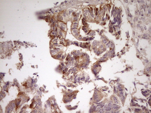 ANGPTL3 Antibody - Immunohistochemical staining of paraffin-embedded Adenocarcinoma of Human colon tissue using anti-ANGPTL3 mouse monoclonal antibody. (Heat-induced epitope retrieval by 1 mM EDTA in 10mM Tris, pH8.5, 120C for 3min,