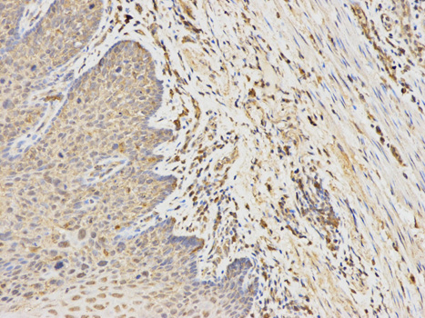 ANGPTL4 Antibody - Immunohistochemistry of paraffin-embedded human esophageal cancer using ANGPTL4 antibody at dilution of 1:100 (200x lens).