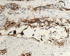 ANGPTL4 Antibody - 1:100 staining human lung carcinoma tissue by IHC-P. The tissue was formaldehyde fixed and a heat mediated antigen retrieval step in citrate buffer was performed. The tissue was then blocked and incubated with the antibody for 1.5 hours at 22°C. An HRP conjugated goat anti-rabbit antibody was used as the secondary.