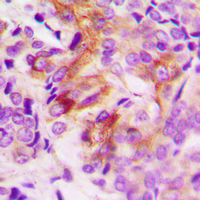 ANGPTL7 / CDT6 Antibody - Immunohistochemical analysis of ANGPTL7 staining in human breast cancer formalin fixed paraffin embedded tissue section. The section was pre-treated using heat mediated antigen retrieval with sodium citrate buffer (pH 6.0). The section was then incubated with the antibody at room temperature and detected using an HRP conjugated compact polymer system. DAB was used as the chromogen. The section was then counterstained with hematoxylin and mounted with DPX.