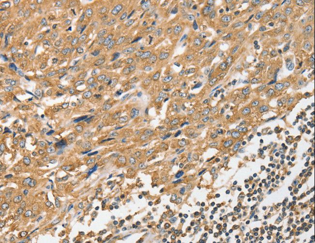 ANGPTL7 / CDT6 Antibody - Immunohistochemistry of paraffin-embedded Human esophagus cancer using ANGPTL7 Polyclonal Antibody at dilution of 1:40.