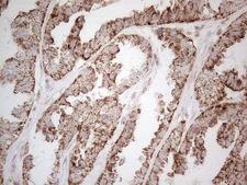 ANGPTL8 / Betatrophin Antibody - Immunohistochemical staining of paraffin-embedded Adenocarcinoma of Human ovary tissue using anti-C19ORF80 mouse monoclonal antibody. (Heat-induced epitope retrieval by 1mM EDTA in 10mM Tris buffer. (pH8.5) at 120°C for 3 min. (1:150)