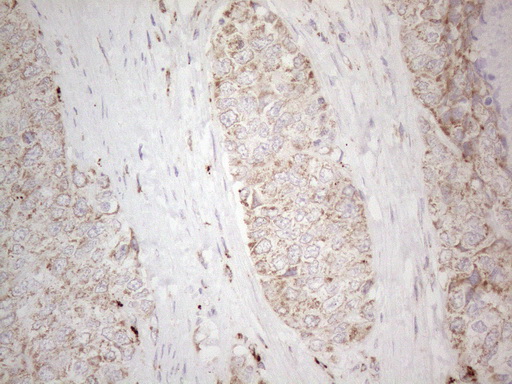 ANGPTL8 / Betatrophin Antibody - Immunohistochemical staining of paraffin-embedded Adenocarcinoma of Human endometrium tissue using anti-C19ORF80 mouse monoclonal antibody. (Heat-induced epitope retrieval by 1mM EDTA in 10mM Tris buffer. (pH8.5) at 120°C for 3 min. (1:150)