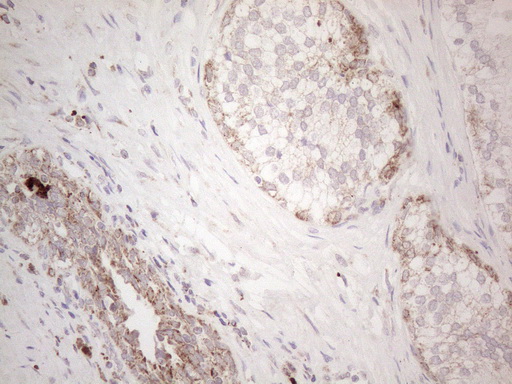 ANGPTL8 / Betatrophin Antibody - Immunohistochemical staining of paraffin-embedded Human prostate tissue within the normal limits using anti-C19ORF80 mouse monoclonal antibody. (Heat-induced epitope retrieval by 1mM EDTA in 10mM Tris buffer. (pH8.5) at 120°C for 3 min. (1:150)