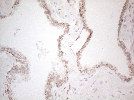 ANGPTL8 / Betatrophin Antibody - Immunohistochemical staining of paraffin-embedded Carcinoma of Human prostate tissue using anti-C19ORF80 mouse monoclonal antibody. (Heat-induced epitope retrieval by 1mM EDTA in 10mM Tris buffer. (pH8.5) at 120°C for 3 min. (1:150)