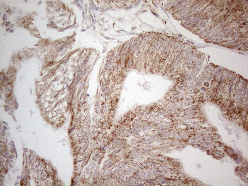 ANGPTL8 / Betatrophin Antibody - Immunohistochemical staining of paraffin-embedded Adenocarcinoma of Human colon tissue using anti-C19ORF80 mouse monoclonal antibody. (Heat-induced epitope retrieval by 1mM EDTA in 10mM Tris buffer. (pH8.5) at 120°C for 3 min. (1:150)