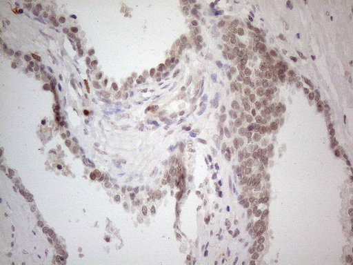 ANGPTL8 / Betatrophin Antibody - Immunohistochemical staining of paraffin-embedded Carcinoma of Human prostate tissue using anti-C19ORF80 mouse monoclonal antibody. (Heat-induced epitope retrieval by 1mM EDTA in 10mM Tris buffer. (pH8.5) at 120°C for 3 min. (1:150)