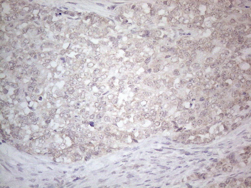 ANGPTL8 / Betatrophin Antibody - Immunohistochemical staining of paraffin-embedded Adenocarcinoma of Human endometrium tissue using anti-C19ORF80 mouse monoclonal antibody. (Heat-induced epitope retrieval by 1mM EDTA in 10mM Tris buffer. (pH8.5) at 120°C for 3 min. (1:150)