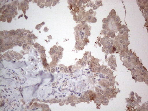 ANGPTL8 / Betatrophin Antibody - Immunohistochemical staining of paraffin-embedded Carcinoma of Human thyroid tissue using anti-C19ORF80 mouse monoclonal antibody. (Heat-induced epitope retrieval by 1mM EDTA in 10mM Tris buffer. (pH8.5) at 120°C for 3 min. (1:150)