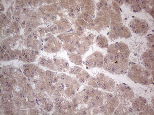 ANGPTL8 / Betatrophin Antibody - Immunohistochemical staining of paraffin-embedded Carcinoma of Human liver tissue using anti-C19ORF80 mouse monoclonal antibody. (Heat-induced epitope retrieval by 1mM EDTA in 10mM Tris buffer. (pH8.5) at 120°C for 3 min. (1:150)