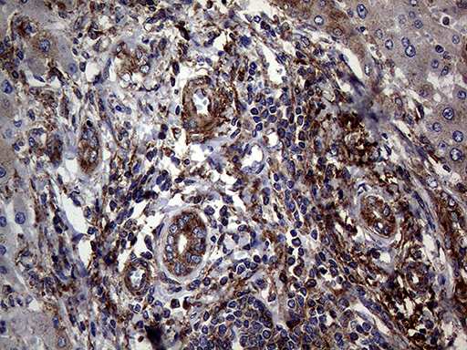 ANGPTL8 / Betatrophin Antibody - Immunohistochemical staining of paraffin-embedded Carcinoma of Human liver tissue using anti-C19ORF80 mouse monoclonal antibody. (Heat-induced epitope retrieval by 1mM EDTA in 10mM Tris buffer. (pH8.5) at 120°C for 3 min. (1:2000)