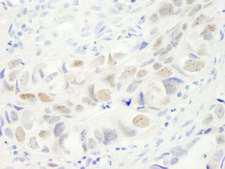 Anillin Antibody - Detection of Human Anillin by Immunohistochemistry. Sample: FFPE section of human colon carcinoma. Antibody: Affinity purified rabbit anti-Anillin used at a dilution of 1:250.