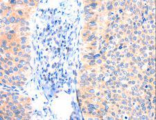 ANK3 / ANKYRIN-G Antibody - Immunohistochemistry of paraffin-embedded Human cervical cancer using ANK3 Polyclonal Antibody at dilution of 1:50.