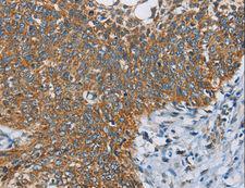 ANKHD1 Antibody - Immunohistochemistry of paraffin-embedded Human thyroid cancer using ANKHD1 Polyclonal Antibody at dilution of 1:40.