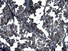 ANKMY2 Antibody - IHC of paraffin-embedded Adenocarcinoma of Human breast tissue using anti-ANKMY2 mouse monoclonal antibody. (Heat-induced epitope retrieval by 1 mM EDTA in 10mM Tris, pH8.5, 120°C for 3min).