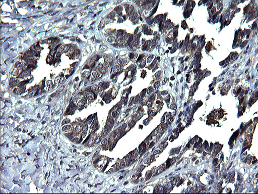 ANKMY2 Antibody - IHC of paraffin-embedded Adenocarcinoma of Human ovary tissue using anti-ANKMY2 mouse monoclonal antibody. (Heat-induced epitope retrieval by 1 mM EDTA in 10mM Tris, pH8.5, 120°C for 3min).