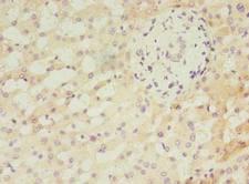 ANKMY2 Antibody - Immunohistochemistry of paraffin-embedded human liver cancer using antibody at dilution of 1:100.