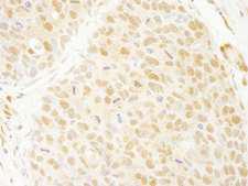 ANKRD17 Antibody - Detection of Human ANKRD17 by Immunohistochemistry. Sample: FFPE section of human breast carcinoma. Antibody: Affinity purified rabbit anti-ANKRD17 used at a dilution of 1:250.