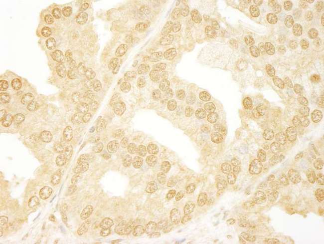 ANKRD17 Antibody - Detection of Human ANKRD17 by Immunohistochemistry. Sample: FFPE section of human prostate carcinoma. Antibody: Affinity purified rabbit anti-ANKRD17 used at a dilution of 1:250.