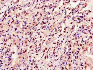ANKRD23 / DARP Antibody - Immunohistochemistry of paraffin-embedded human lung cancer using ANKRD23 Antibody at dilution of 1:100
