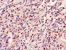 ANKRD23 / DARP Antibody - Immunohistochemistry of paraffin-embedded human lung cancer using ANKRD23 Antibody at dilution of 1:100