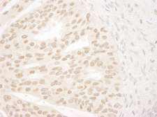 ANKRD28 Antibody - Detection of Human ANKRD28/PITK by Immunohistochemistry. Sample: FFPE section of human prostate carcinoma. Antibody: Affinity purified rabbit anti-ANKRD28/PITK used at a dilution of 1:1000 (0.2 ug/ml).