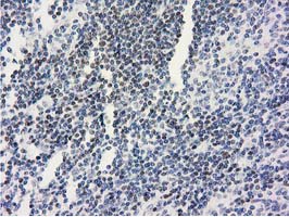 ANKRD53 Antibody - IHC of paraffin-embedded Human lymphoma tissue using anti-ANKRD53 mouse monoclonal antibody.