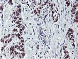 ANKRD53 Antibody - IHC of paraffin-embedded Carcinoma of Human lung tissue using anti-ANKRD53 mouse monoclonal antibody.