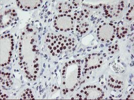 ANKRD53 Antibody - IHC of paraffin-embedded Carcinoma of Human thyroid tissue using anti-ANKRD53 mouse monoclonal antibody.