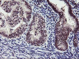 ANKRD53 Antibody - IHC of paraffin-embedded Adenocarcinoma of Human endometrium tissue using anti-ANKRD53 mouse monoclonal antibody.