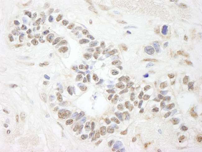 ANKS3 Antibody - Detection of Human ANKS3 by Immunohistochemistry. Sample: FFPE section of human breast carcinoma. Antibody: Affinity purified rabbit anti-ANKS3 used at a dilution of 1:250.