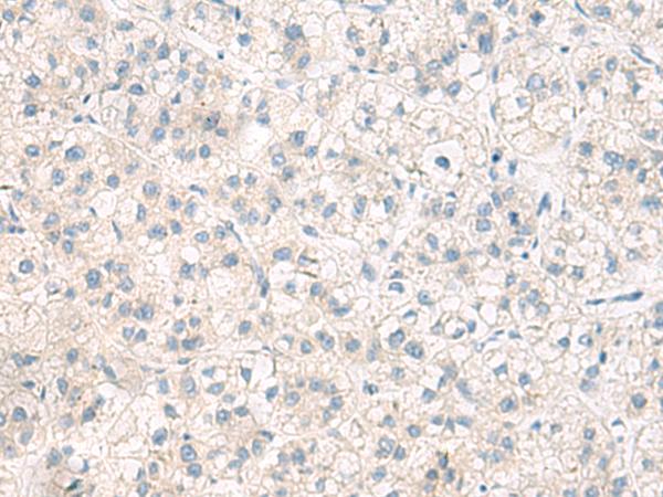 ANKS6 Antibody - Immunohistochemistry of paraffin-embedded Human liver cancer tissue  using ANKS6 Polyclonal Antibody at dilution of 1:55(×200)
