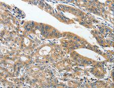 ANKZF1 Antibody - Immunohistochemistry of paraffin-embedded Human gastric cancer using ANKZF1 Polyclonal Antibody at dilution of 1:40.