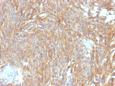 ANO1 / DOG1 / TMEM16A Antibody - Formalin-fixed, paraffin-embedded human GIST stained with DOG-1 Rabbit Recombinant Monoclonal Antibody (DG1/2564R).