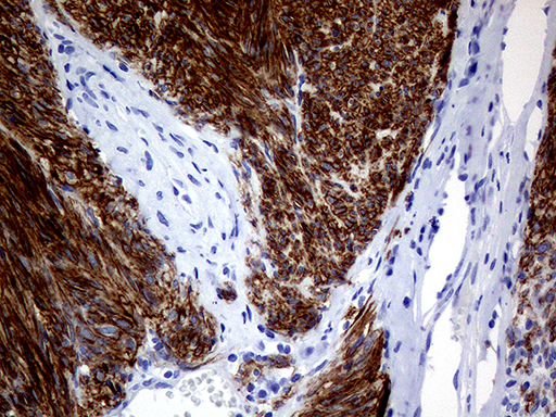 ANO1 / DOG1 / TMEM16A Antibody - Immunohistochemical staining of paraffin-embedded Human gastric stromal tumor tissue using anti-ANO1 mouse monoclonal antibody. (Heat-induced epitope retrieval by Tris-EDTA(1:1000)