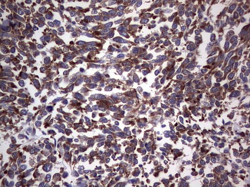 ANO1 / DOG1 / TMEM16A Antibody - Immunohistochemical staining of paraffin-embedded Human melanoma tissue using anti-ANO1 mouse monoclonal antibody. (Heat-induced epitope retrieval by 1 mM EDTA in 10mM Tris, pH8.5, 120C for 3min,