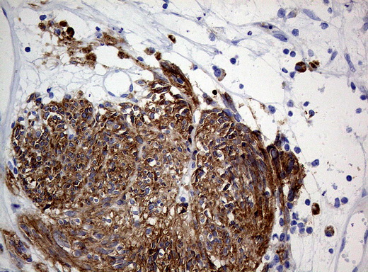 ANO1 / DOG1 / TMEM16A Antibody - Immunohistochemical staining of paraffin-embedded Human gastric stromal tumor tissue using anti-ANO1 mouse monoclonal antibody. (Heat-induced epitope retrieval by 1mM EDTA in 10mM Tris buffer. (pH8.0) at 120°C for 3 min. (1:1000)