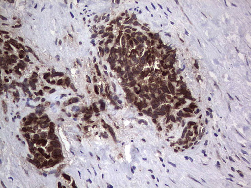 ANO1 / DOG1 / TMEM16A Antibody - IHC of paraffin-embedded Human testicular cancer tissue using anti-ANO1 mouse monoclonal antibody. (Heat-induced epitope retrieval by 1 mM EDTA in 10mM Tris, pH8.5, 120°C for 3min).