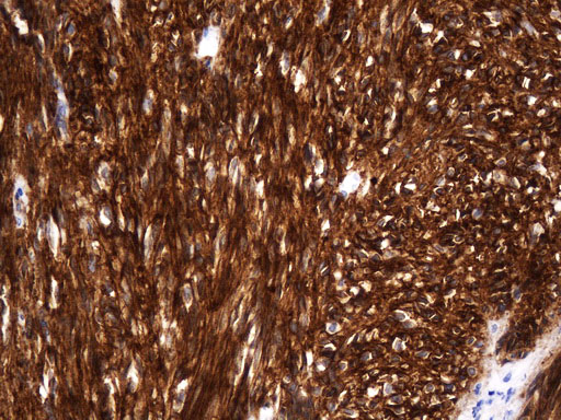 ANO1 / DOG1 / TMEM16A Antibody - Immunohistochemical staining of paraffin-embedded Human gastric stromal tumor tissue using anti-ANO1. (Dog1) mouse monoclonal antibody. (Heat-induced epitope retrieval by Tris-EDTAin 10mM Tris buffer. (pH8.0) at 120°C for 2.5 min. (1:2000)