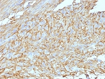 ANO1 / DOG1 / TMEM16A Antibody - Formalin-fixed, paraffin-embedded human GIST stained with DOG1 antibody (DG1/447 + DOG-1.1).  This image was taken for the unmodified form of this product. Other forms have not been tested.